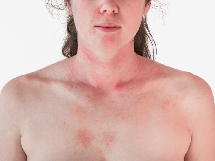 Come ci si libera dell’eczema sul viso e sul collo?