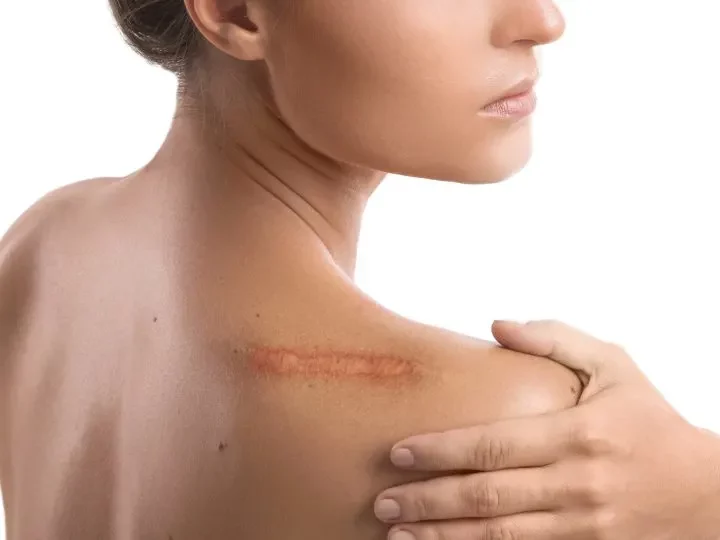 Come evitare la cicatrice ipertrofica?
