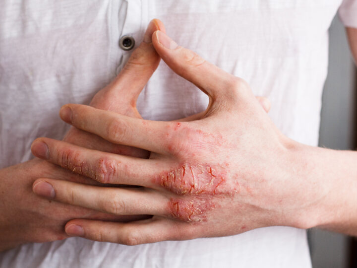 Eczema: quale rimedio miracoloso funziona davvero?